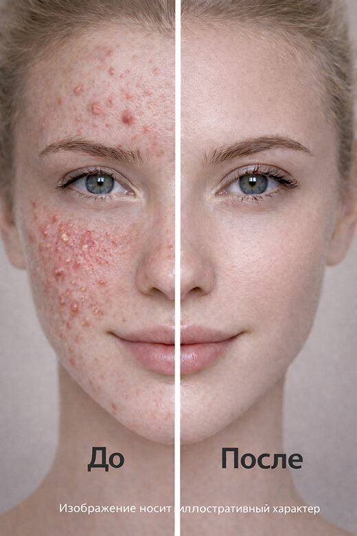 Следоцид Тональный Антикомедогенный ВВ