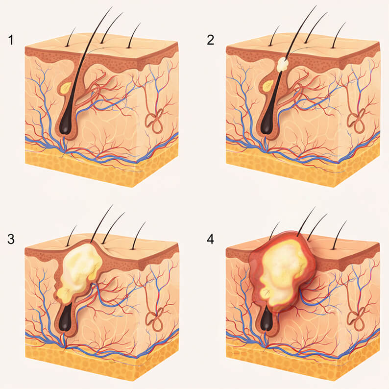 Механизм развития прыща